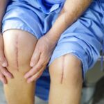 knee replacement surgery in India