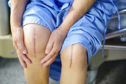 knee replacement surgery in India